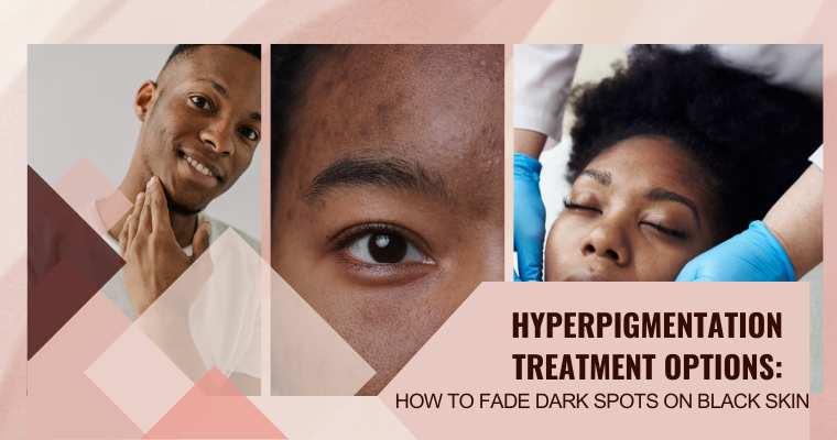 How To Fade Dark Spots