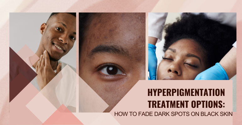 How To Fade Dark Spots